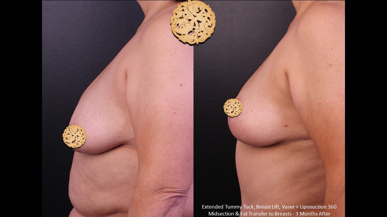 Fat Transfer To Breasts Before & After