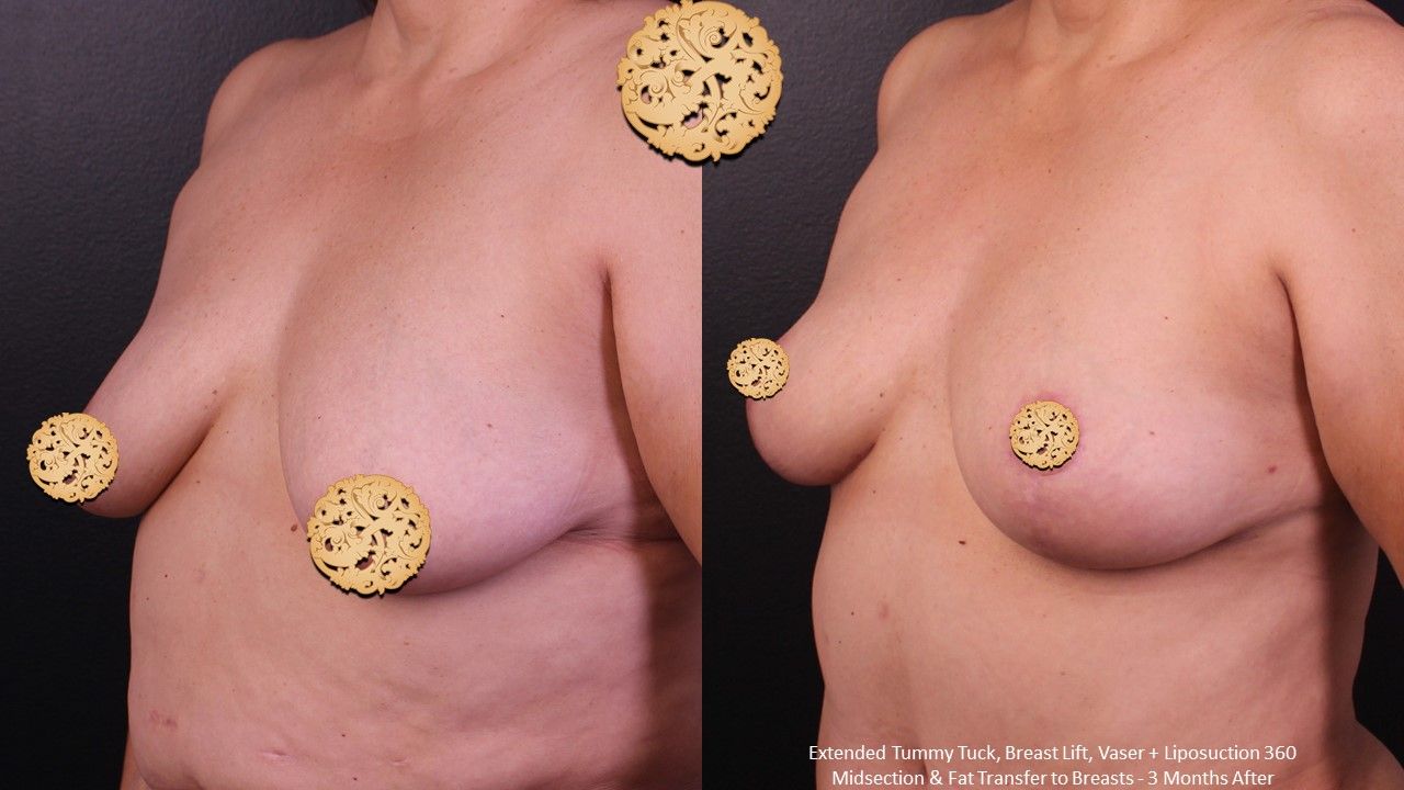 Fat Transfer To Breasts Before & After