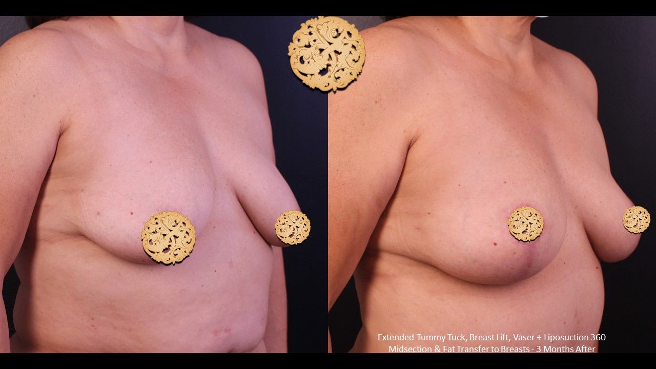 Fat Transfer To Breasts Before & After