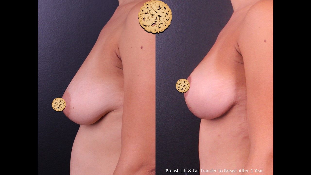 Fat Transfer To Breasts Before & After