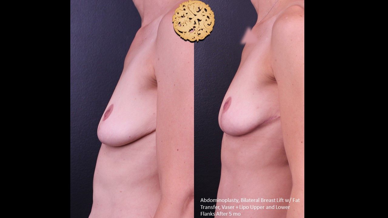 Fat Transfer To Breasts Before & After