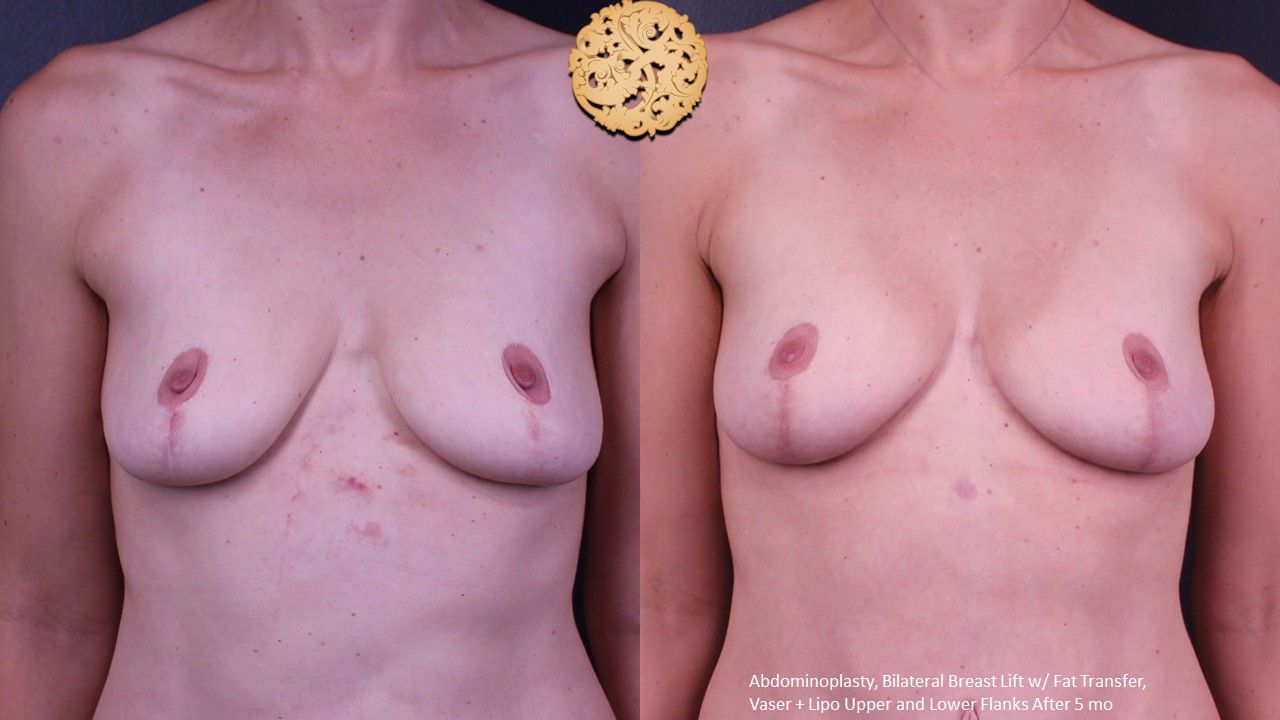 Fat Transfer To Breasts Before & After