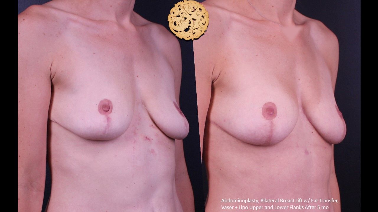 Fat Transfer To Breasts Before & After