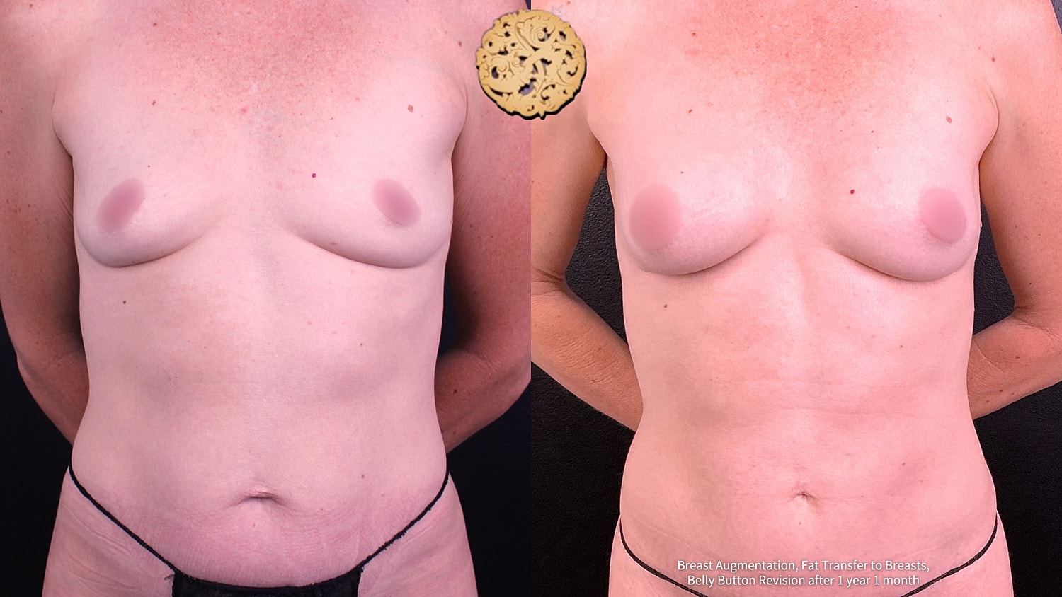Fat Transfer To Breasts Before & After