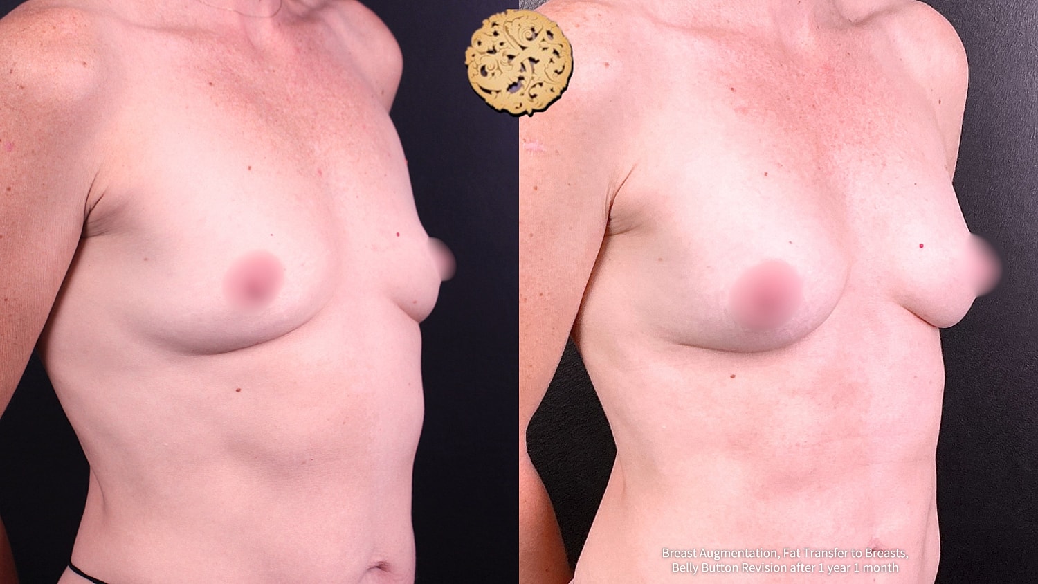 Fat Transfer To Breasts Before & After