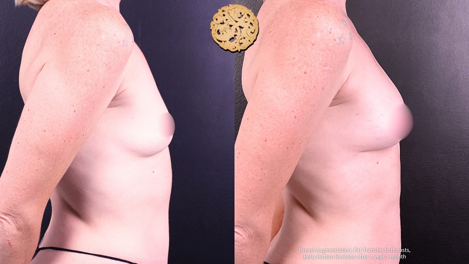 Fat Transfer To Breasts Before & After