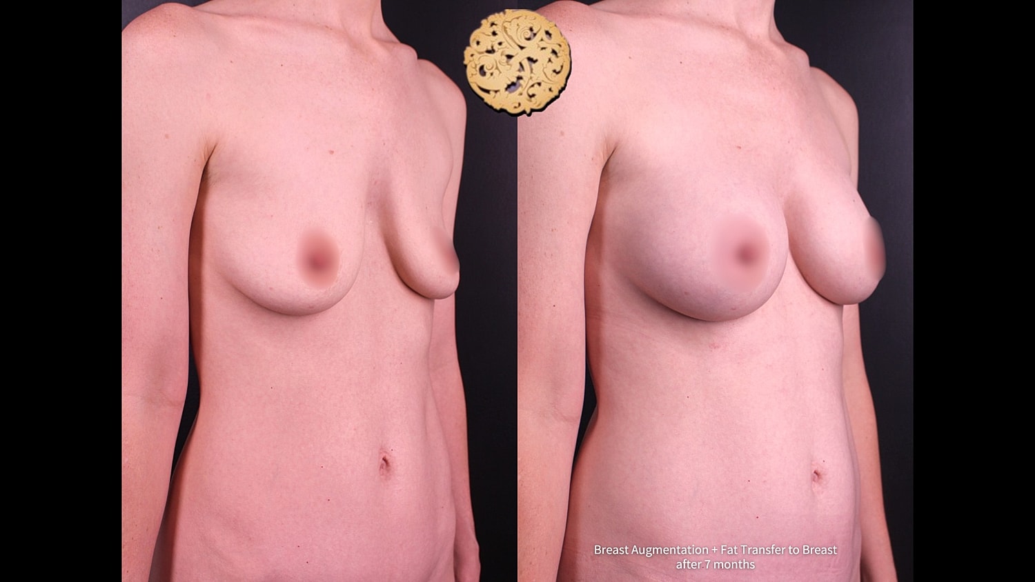 Breast augmentation results after seven months.