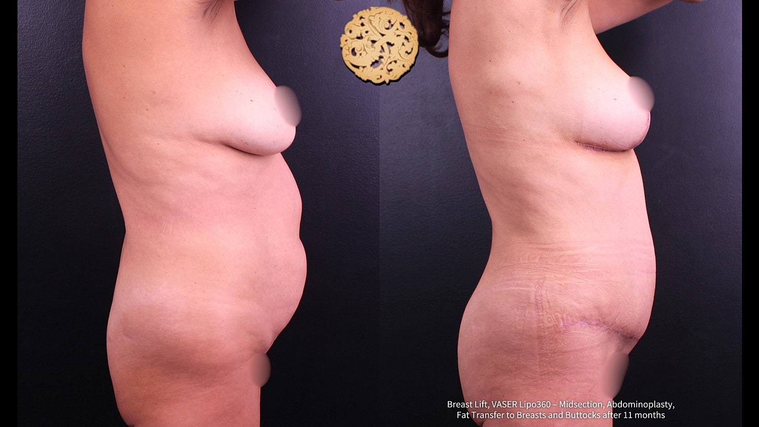 Fat Transfer To Breasts Before & After