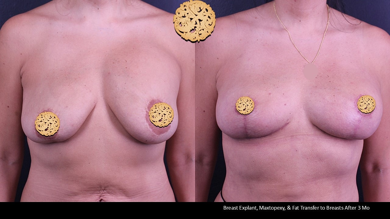 Breast surgery before and after comparison image