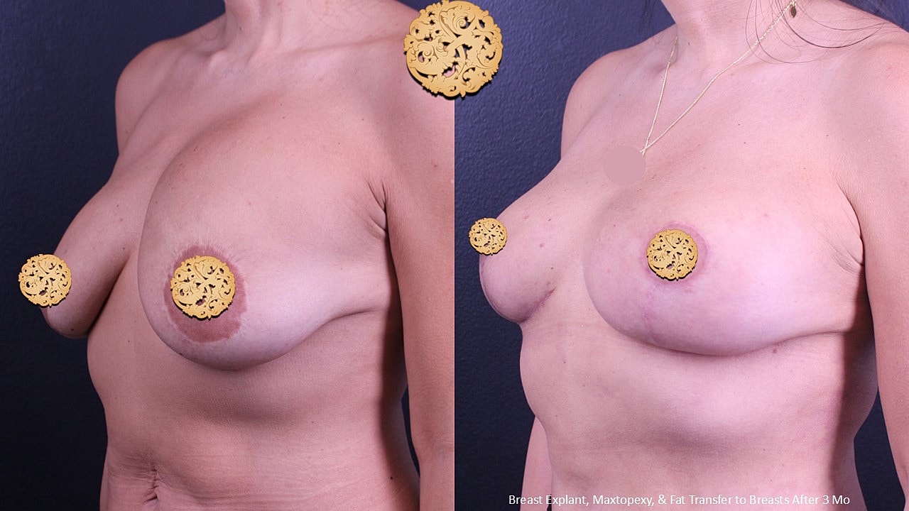 Breast transformation before and after surgery.