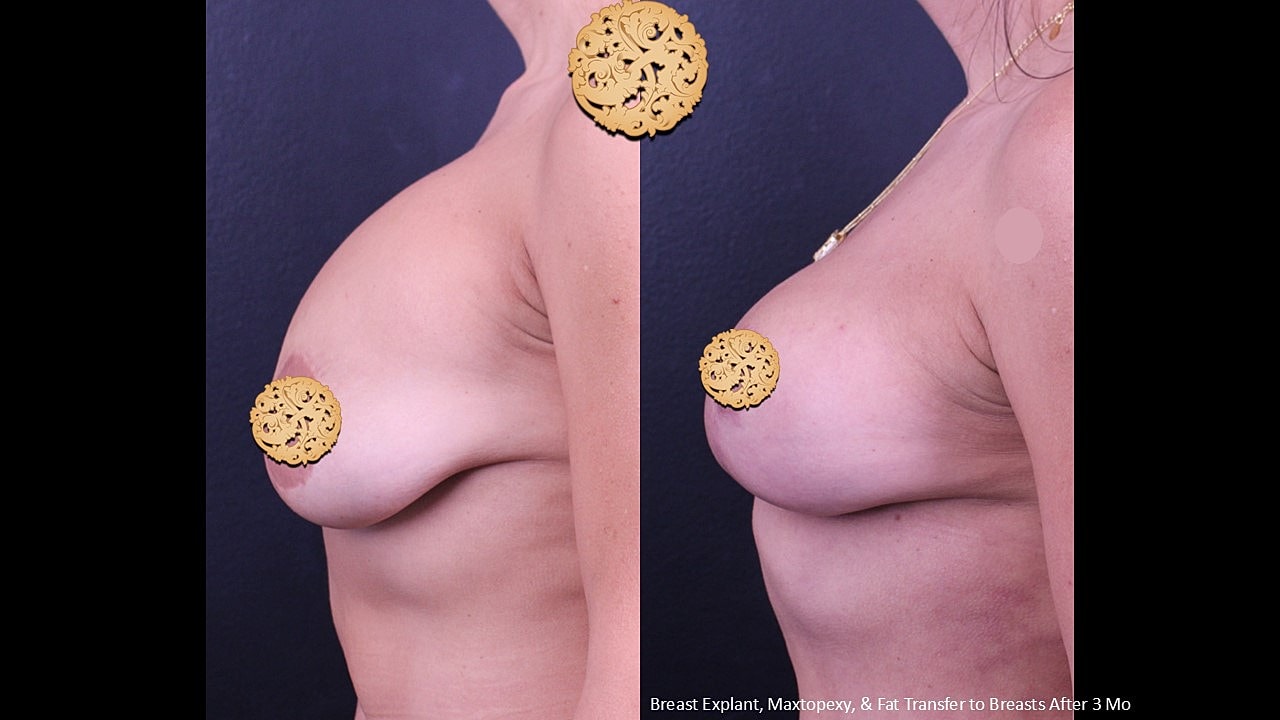 Before and after breast procedure comparison image.