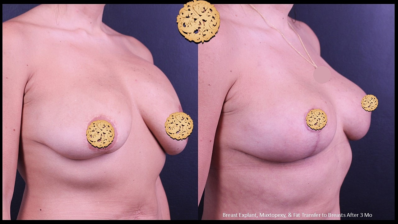 Before and after breast surgery comparison image.