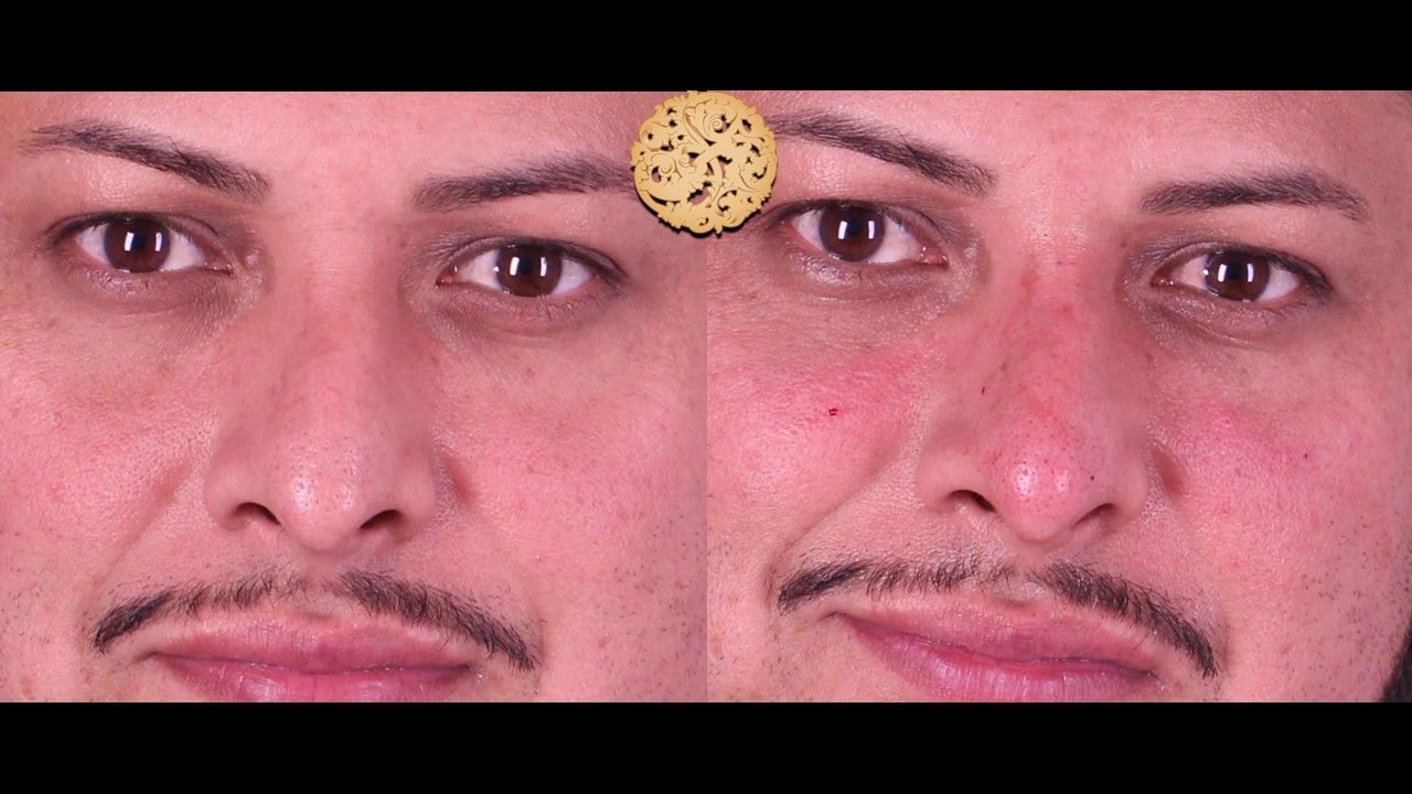 Non Surgical Nose Job Before & After