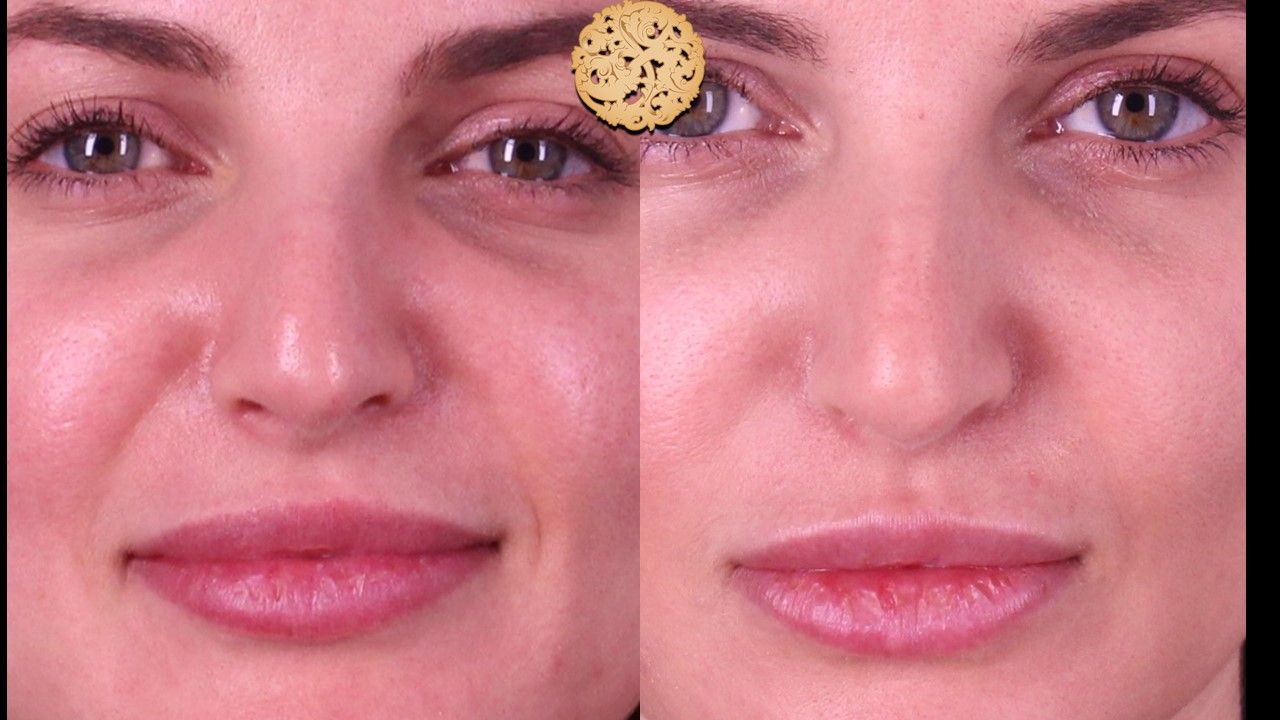 Non Surgical Nose Job Before & After