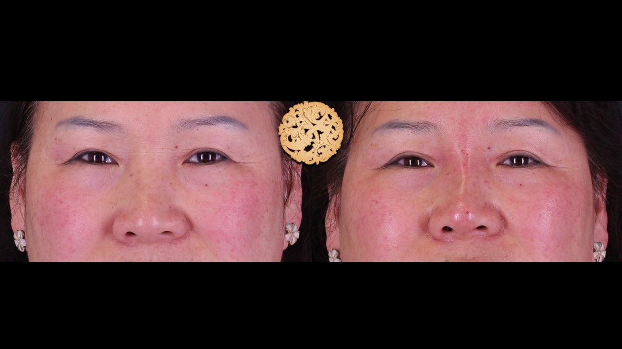 Non Surgical Nose Job Before & After