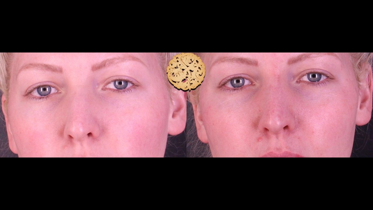 Non Surgical Nose Job Before & After