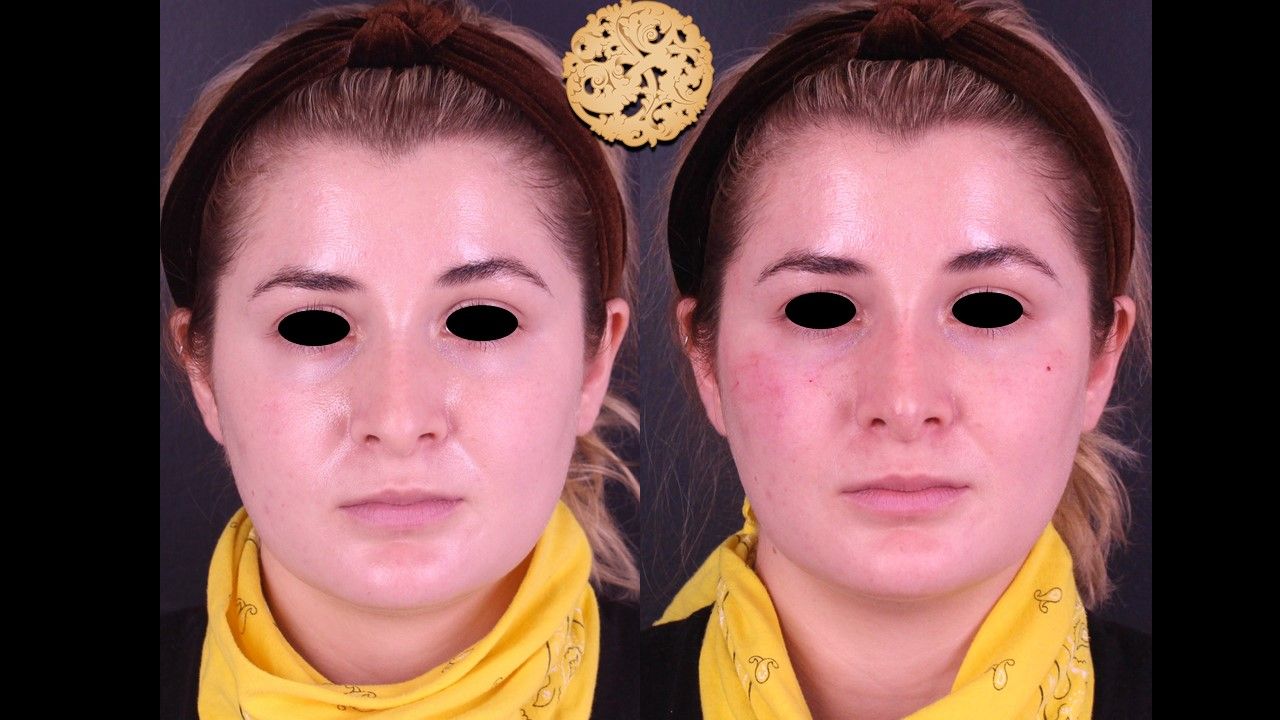 Non Surgical Nose Job Before & After