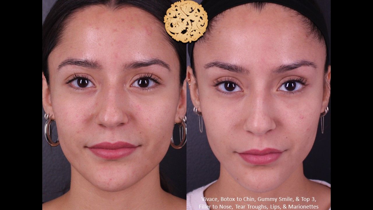 Non Surgical Nose Job Before & After