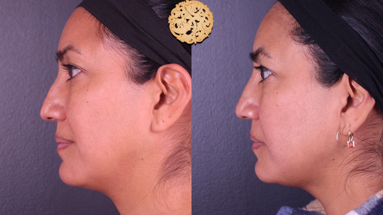 Non Surgical Nose Job Before & After