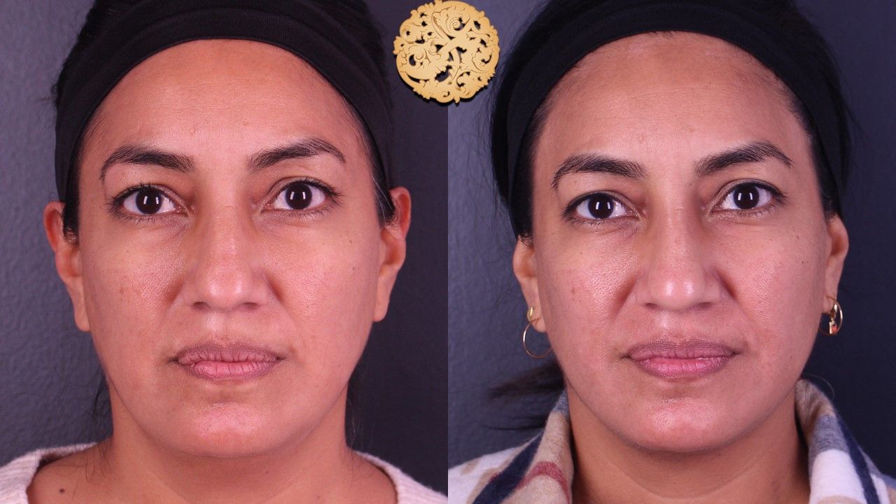 Non Surgical Nose Job Before & After