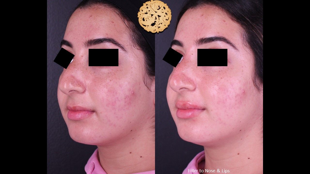 Non Surgical Nose Job Before & After