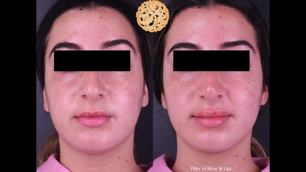 Non Surgical Nose Job Before & After