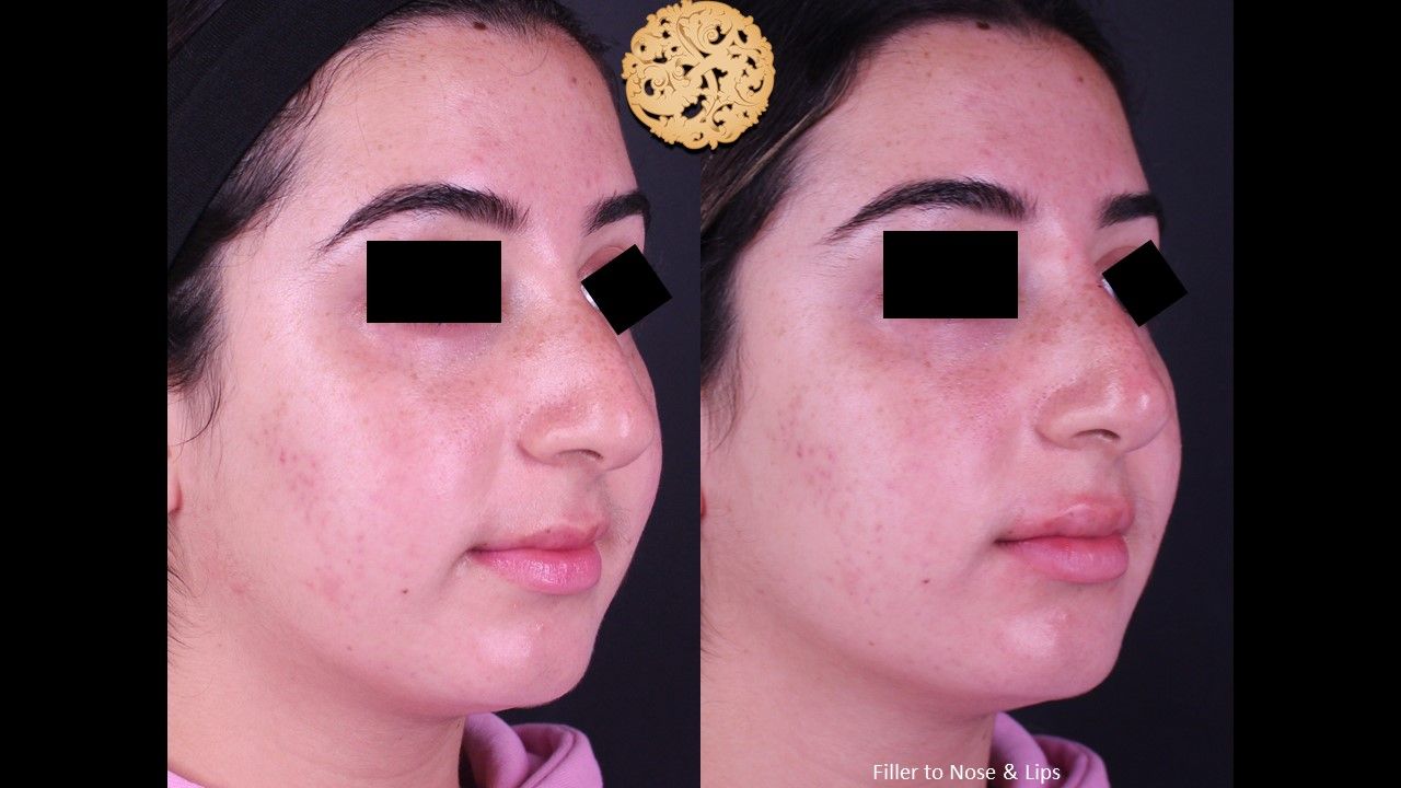 Non Surgical Nose Job Before & After