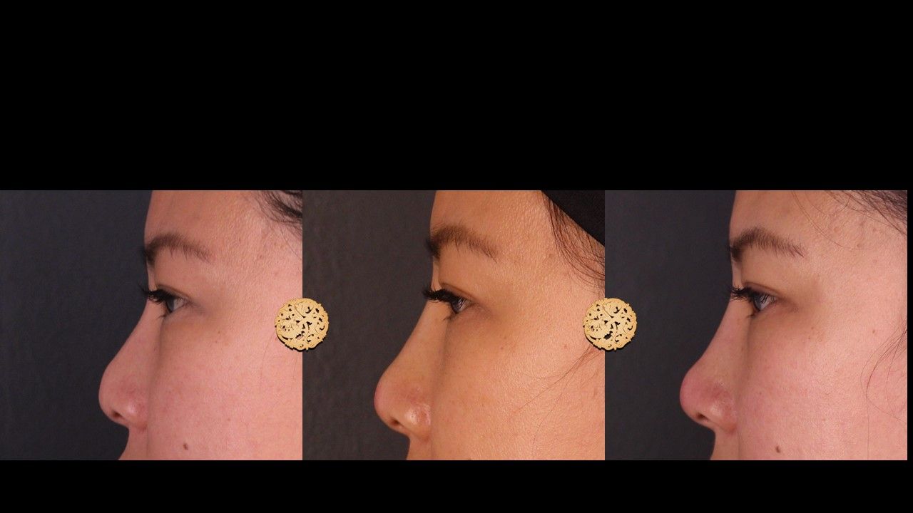 Non Surgical Nose Job Before & After