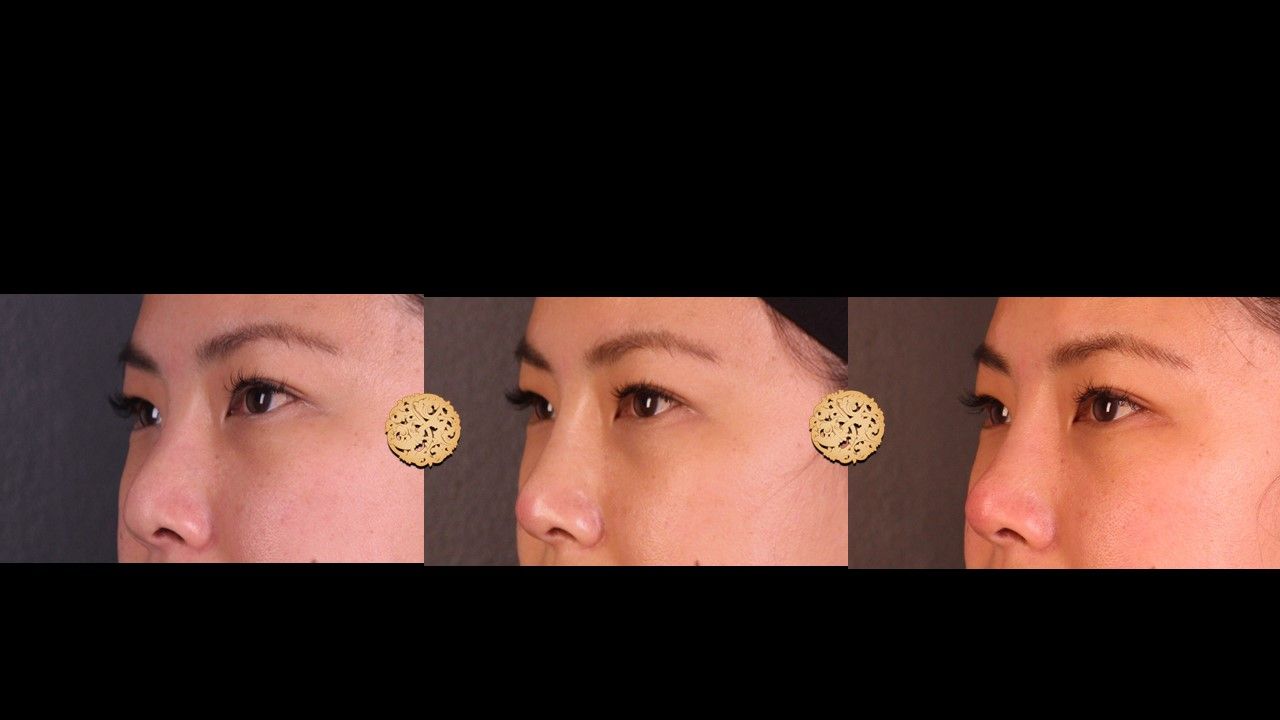 Non Surgical Nose Job Before & After