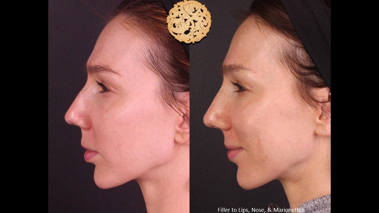 Non Surgical Nose Job Before & After
