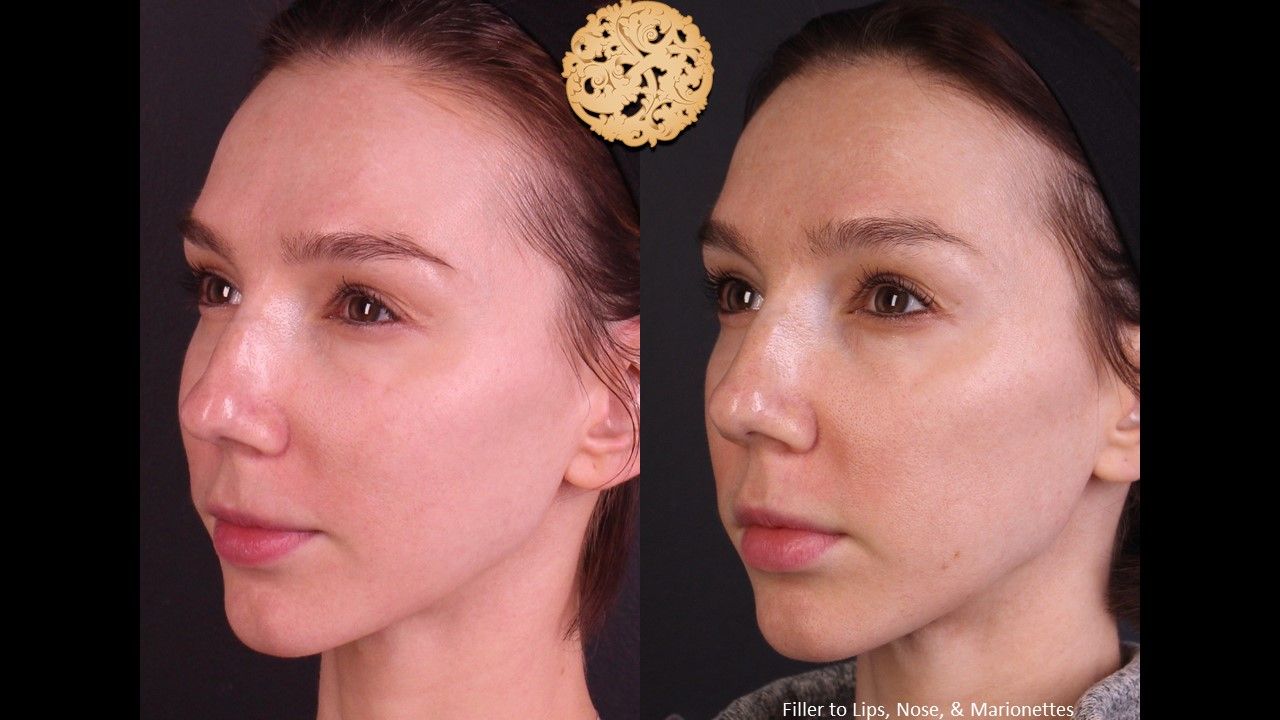 Non Surgical Nose Job Before & After