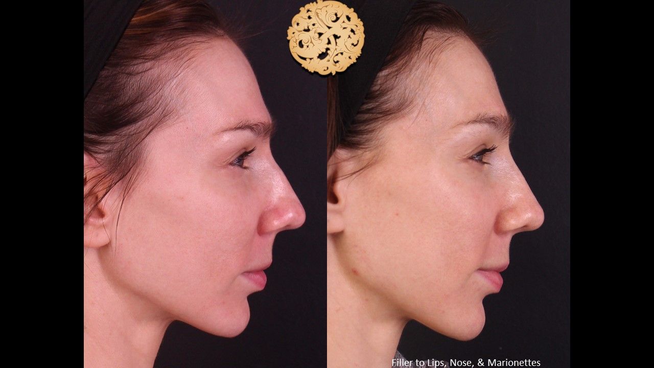 Non Surgical Nose Job Before & After