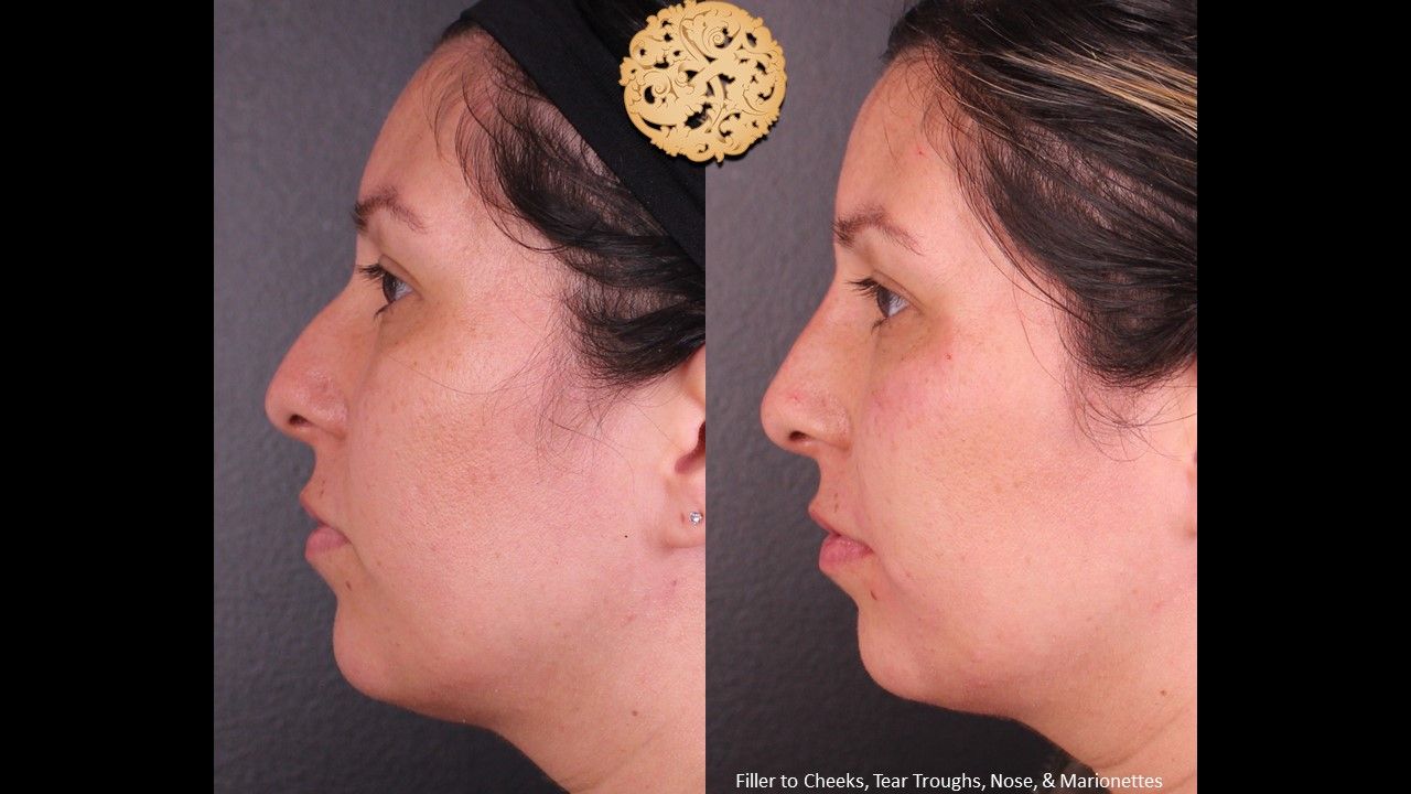 Non Surgical Nose Job Before & After