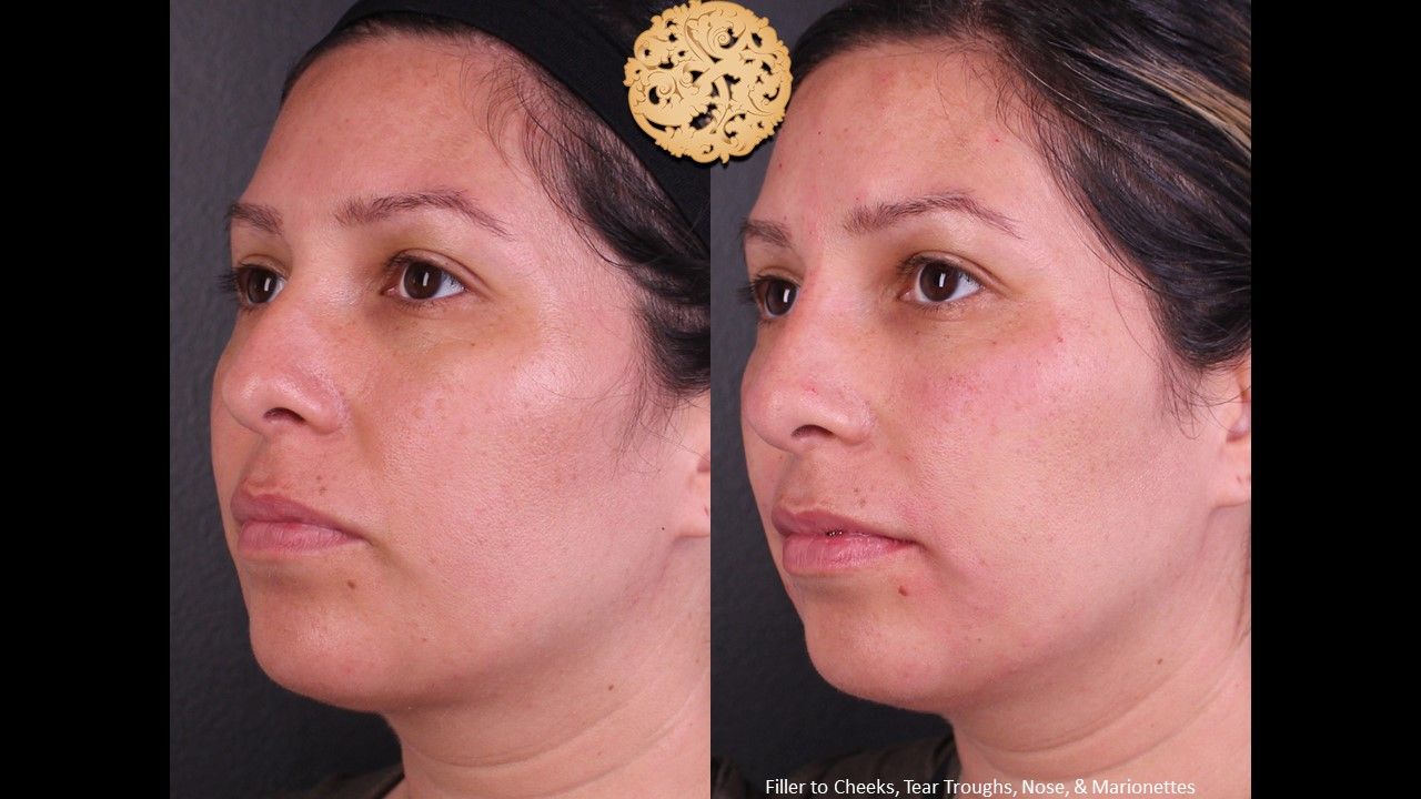 Non Surgical Nose Job Before & After