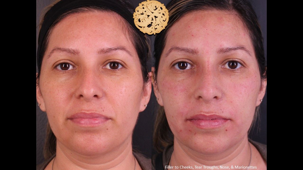 Non Surgical Nose Job Before & After