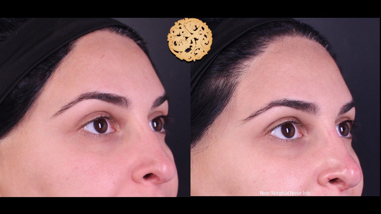 Non Surgical Nose Job Before & After