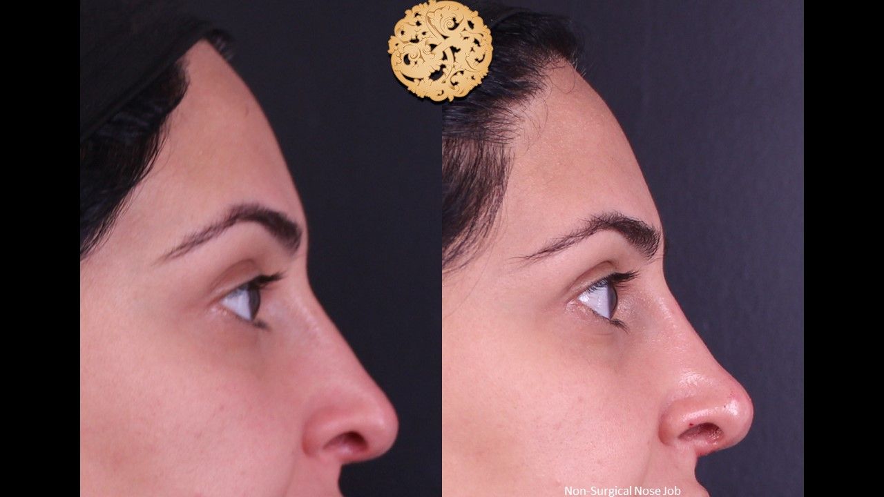 Non Surgical Nose Job Before & After