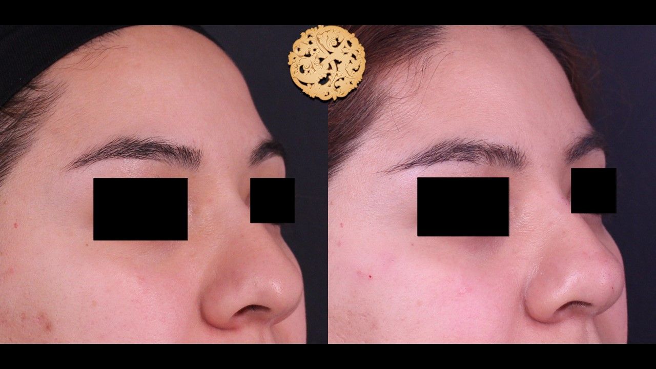 Non Surgical Nose Job Before & After