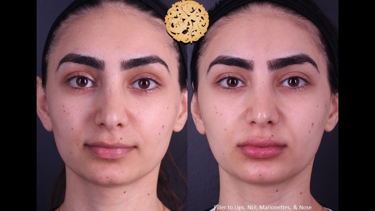 Non Surgical Nose Job Before & After