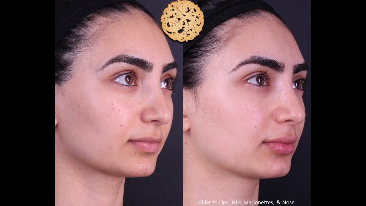 Non Surgical Nose Job Before & After