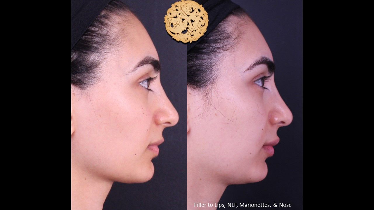 Non Surgical Nose Job Before & After