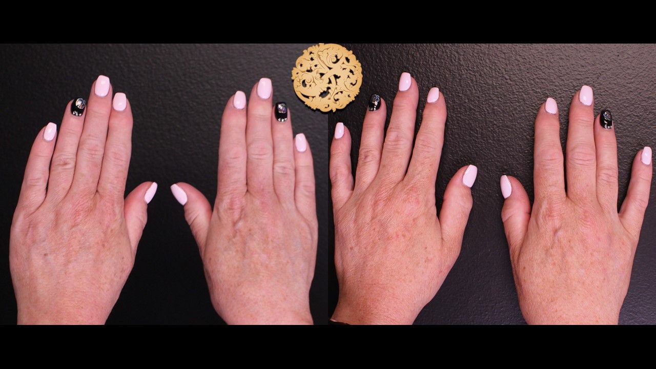 Hand Rejuvenation Before & After