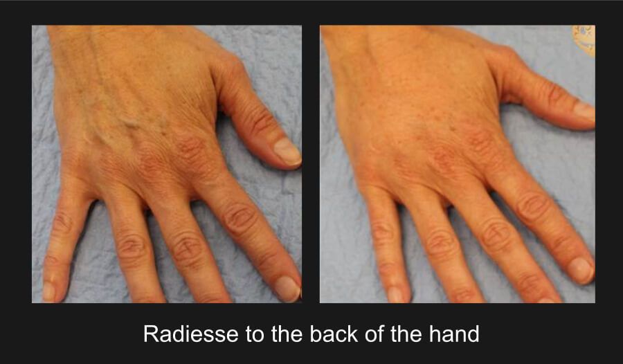 Hand Rejuvenation Before & After