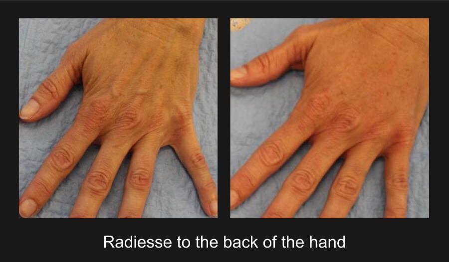 Hand Rejuvenation Before & After