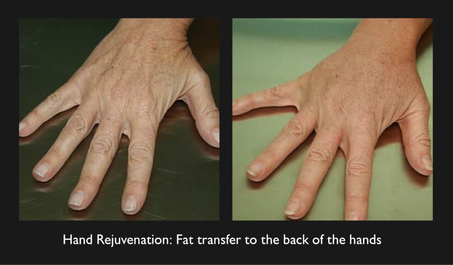 Hand Rejuvenation Before & After