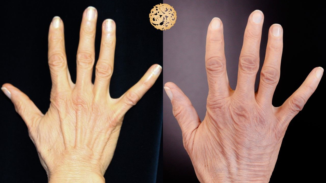 Hand Rejuvenation Before & After