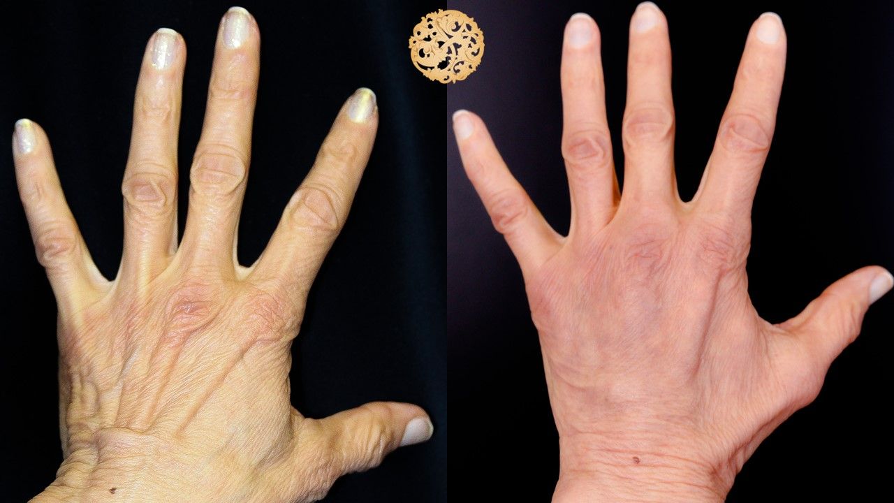 Hand Rejuvenation Before & After