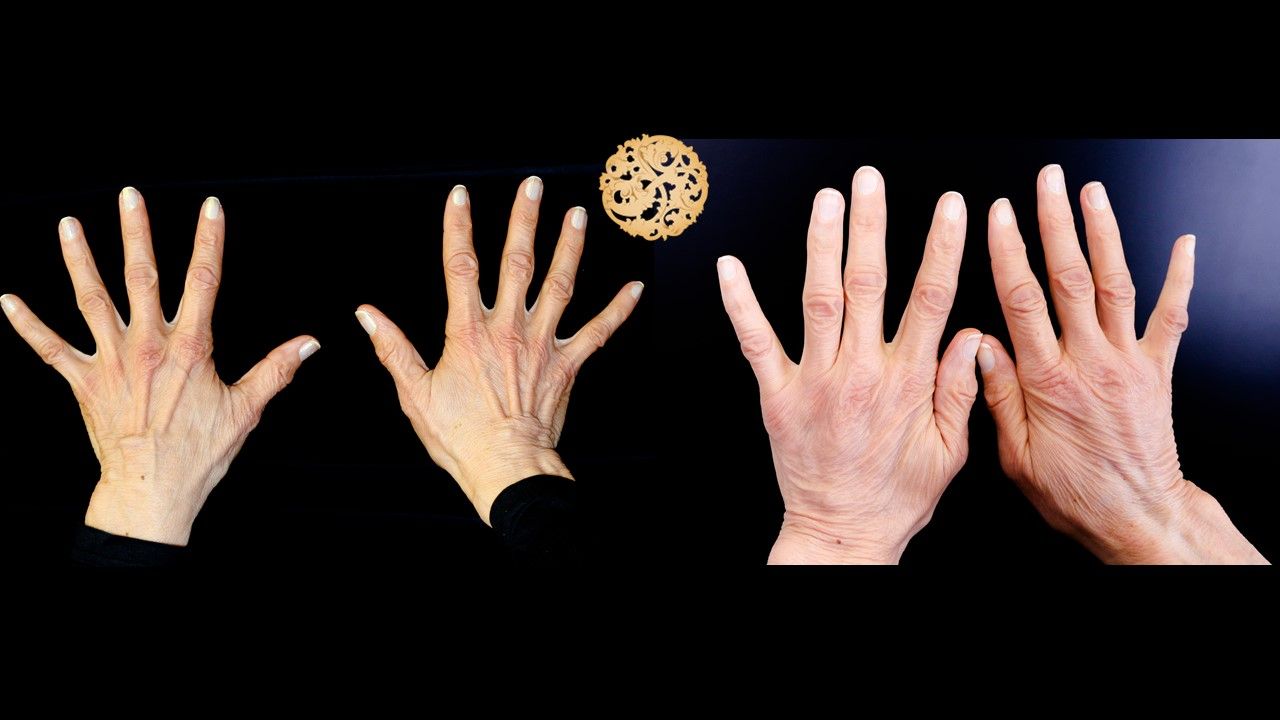Hand Rejuvenation Before & After