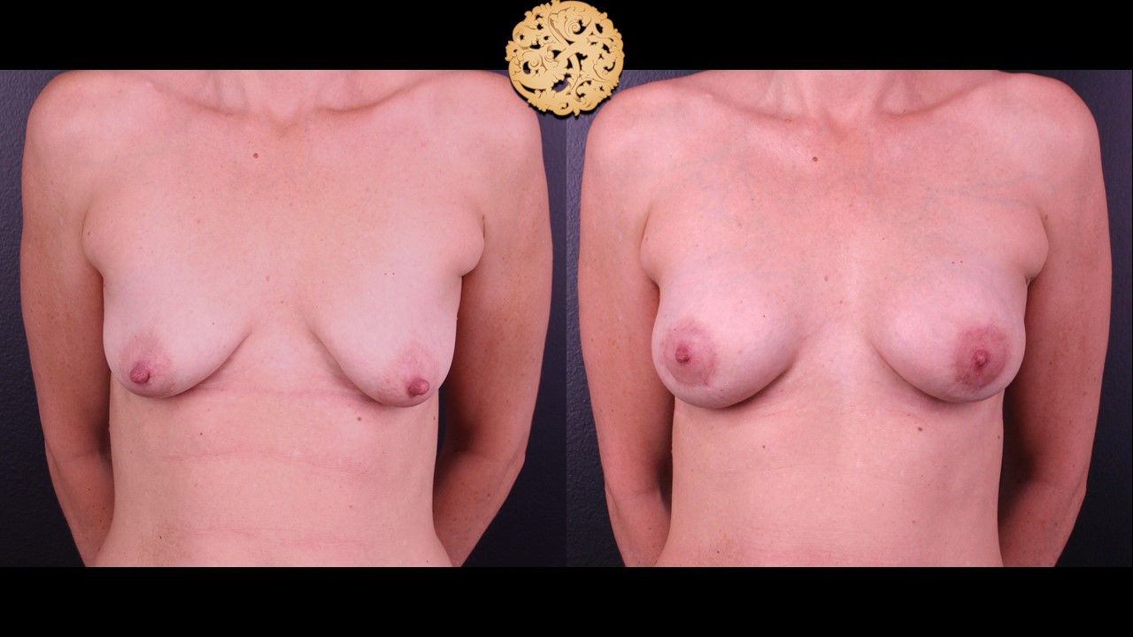 Nipple Reduction Before & After