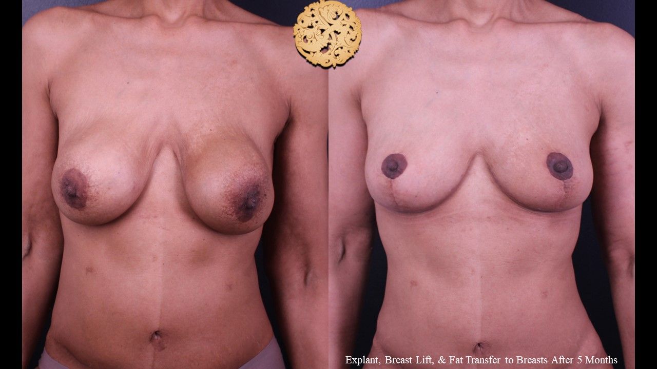 Nipple Reduction Before & After